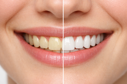 BLANQUEADOR DENTAL UV – KIT CON LUZ LED